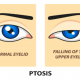 Fakta-fakta Ptosis, Kelainan pada Kelopak Mata dan Penyebabnya