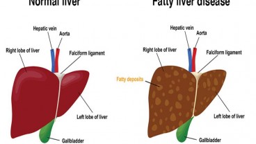 Mengenal Gejala, Penyebab dan Cara Pencegahan Fatty Liver, Bisa Berubah jadi Kanker Hati