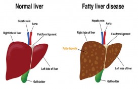 Mengenal Gejala, Penyebab dan Cara Pencegahan Fatty Liver, Bisa Berubah jadi Kanker Hati