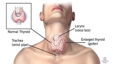 Tanda Kelenjar Tiroid Anda Berubah Menjadi Kanker