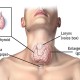 Tanda Kelenjar Tiroid Anda Berubah Menjadi Kanker