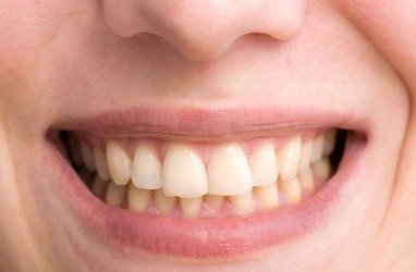 Penyebab Gigi Kuning dan Cara Mengatasinya