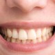 Daftar Perawatan Gigi yang Ditanggung BPJS Kesehatan