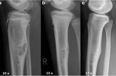 Gejala Kanker Tulang yang Harus Diwaspadai, Jangan Abaikan Bengkak dan Nyeri Tulang