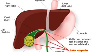 Gejala, Penyebab dan Cara Mencegah Terjadinya Batu Empedu