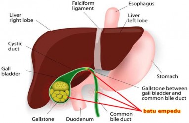 Gejala, Penyebab dan Cara Mencegah Terjadinya Batu Empedu