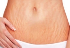 Cara Mencegah dan Memudarkan Stretch Mark