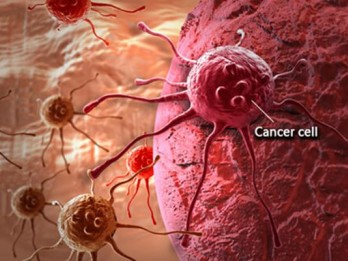Penyebab Kanker Kolorektal di Kalangan Anak Muda