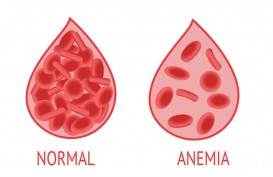 Apa Penyebab Anemia Aplastik? Begini Penjelasan dan Cara Pengobatannya