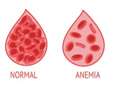 Apa Penyebab Anemia Aplastik? Begini Penjelasan dan Cara Pengobatannya