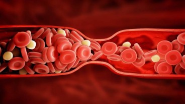 Fakta-fakta Penyakit Sepsis, Sebabkan Pembekuan Darah hingga Berujung Kematian