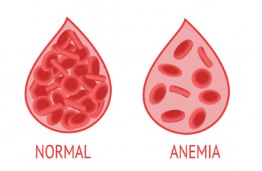 Benarkah Obat Sakit Kepala Picu Anemia Aplastik? Ini Kata Pakar