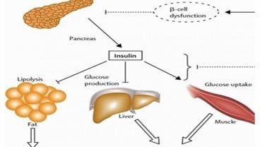 Jenis-jenis Insulin untuk Penderita Diabetes Tipe 1, Kasusnya Kian Tinggi di Indonesia