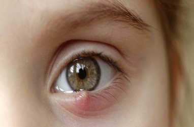 Penyebab Mata Bintitan dan Cara Mencegahnya