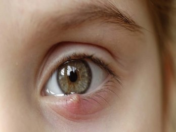 Penyebab Mata Bintitan dan Cara Mencegahnya