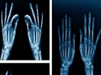 Siemens dan Hermina Group Kerja Sama dalam Inovasi Teknologi X-Ray