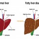 Ini Tanda Penyakit Liver Pada Kulit