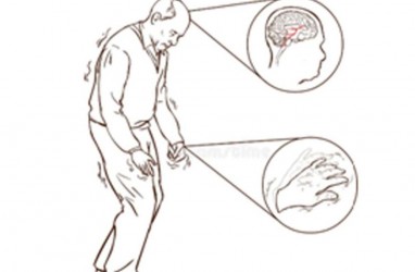 Kekurangan Vitamin B Berisiko Terserang Parkinson?