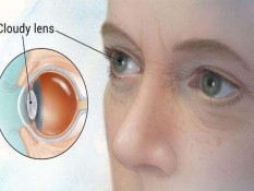 Ciri dan Gejala Katarak, 51% Penderita Tak Sadar Hingga Berpotensi Alami Kebutaan