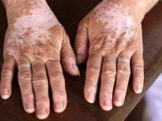Pengertian Penyakit Vitiligo, Penyebab, Perawatan, dan Menjaga Pasien