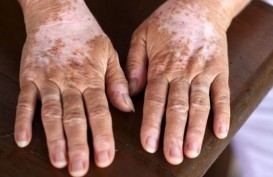 Pengertian Penyakit Vitiligo, Penyebab, Perawatan, dan Menjaga Pasien