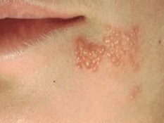 Kenali Penyebab dan Cara Mencegah Herpes Zoster