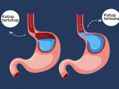 GERD Tak Kunjung Sembuh, Perlukah Laparaskopi?