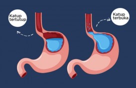 GERD Tak Kunjung Sembuh, Perlukah Laparaskopi?