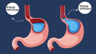 GERD Tak Kunjung Sembuh, Perlukah Laparaskopi?