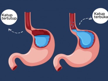 GERD Tak Kunjung Sembuh, Perlukah Laparaskopi?