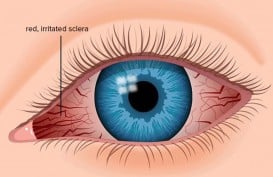 Menggosok Mata Berlebihan Bisa Bikin Infeksi hingga Kerusakan Retina