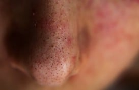 6 Kebiasaan yang Bisa Memicu Penyakit Telinga Hidung Tenggorokan atau THT