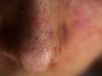 6 Kebiasaan yang Bisa Memicu Penyakit Telinga Hidung Tenggorokan atau THT