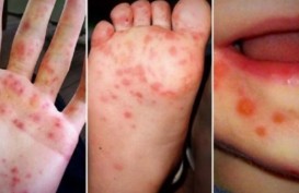 Kasus Meningkat, Kenali Gejala dan Cara Penanganan Flu Singapura pada Anak