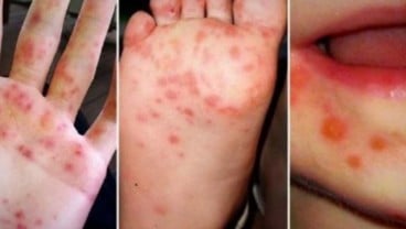 Kasus Meningkat, Kenali Gejala dan Cara Penanganan Flu Singapura pada Anak