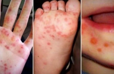 Kasus Meningkat, Kenali Gejala dan Cara Penanganan Flu Singapura pada Anak