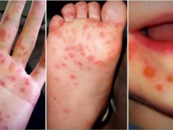 Kasus Meningkat, Kenali Gejala dan Cara Penanganan Flu Singapura pada Anak