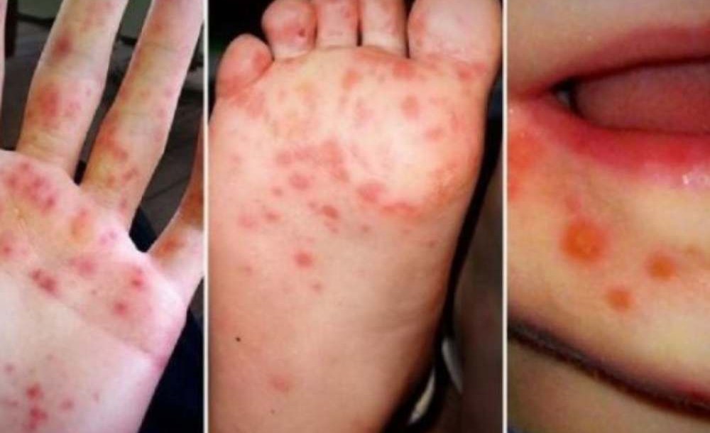 Kasus Meningkat, Kenali Gejala dan Cara Penanganan Flu Singapura pada Anak