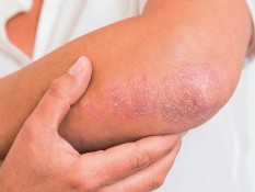 Gejala dan Penanganan Psoriasis, Simak Lengkapnya