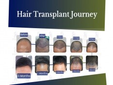 Berapa Biaya Transplantasi Rambut yang Kini Sedang Tren?