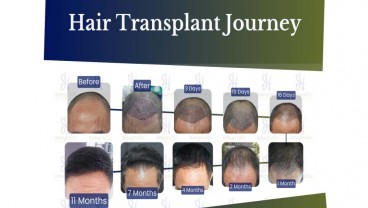 Berapa Biaya Transplantasi Rambut yang Kini Sedang Tren?