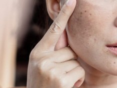 Seorang Perempuan Meninggal Dunia Usai Treatment Sinar Laser Hilangkan Dark Spot