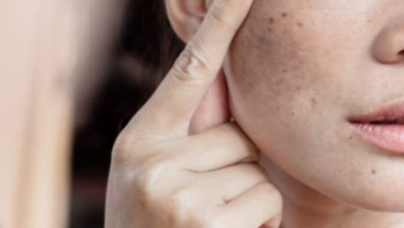 Seorang Perempuan Meninggal Dunia Usai Treatment Sinar Laser Hilangkan Dark Spot