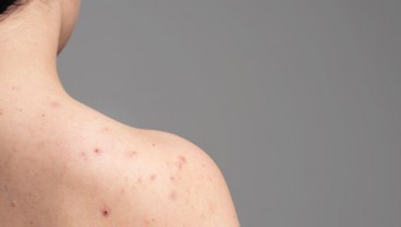 Tips Sehat, 4 Cara Hilangkan Jerawat Punggung