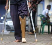 Pemasangan Bantuan Kaki Palsu Di Banda Aceh