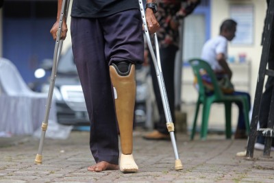 Pemasangan Bantuan Kaki Palsu Di Banda Aceh