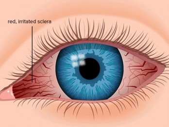 TIPS DOKTER: Mata Tegang dan Cara Mengatasinya