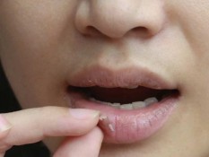 Tips Mengatasi Bibir Kering dan Pecah-pecah