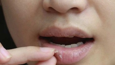 Tips Mengatasi Bibir Kering dan Pecah-pecah