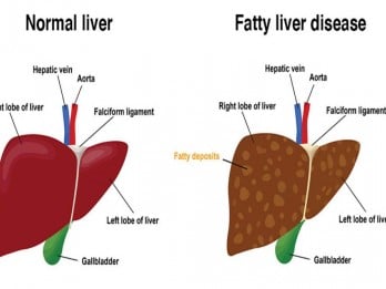 Ciri-ciri Sakit Liver yang Muncul di Tubuh Anda